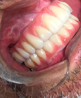 Implante Dentário - Caso 02