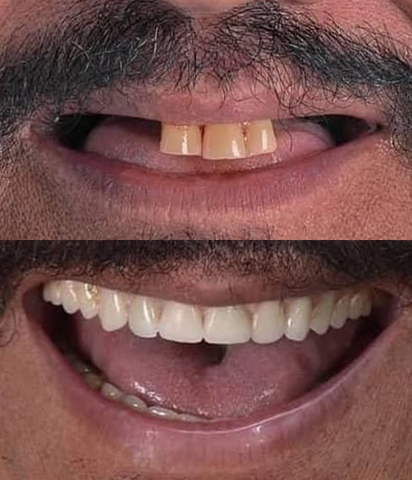 Implante dentário